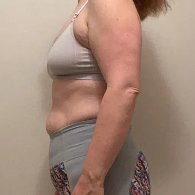 Before-and-after image of Prolific Health client’s successful weight loss transformation.